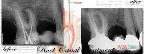 02 root canal treatment