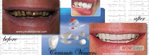 ceramic_veneers01