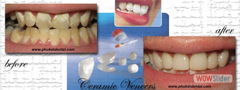 ceramic_veneers02