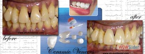 ceramic_veneers03