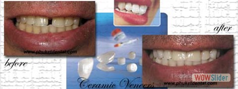 ceramic_veneers04