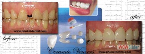 ceramic_veneers05