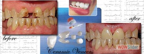 ceramic_veneers06