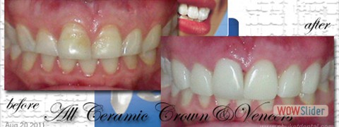 ceramic_veneers07