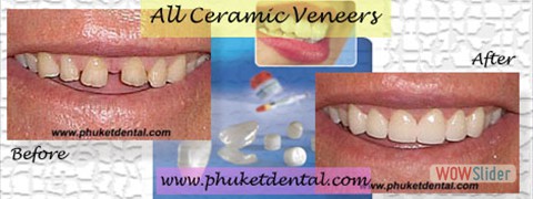 ceramic veneers08