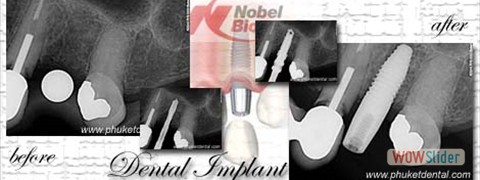 dental_implant_xray07