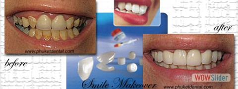 smile_makeover02