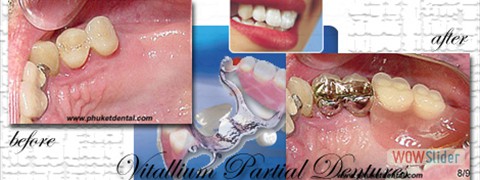 vitallium_partial_denture01