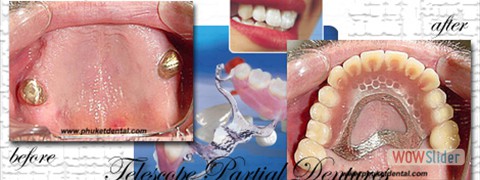 vitallium_partial_denture03