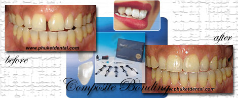 Composite Bonding by Phuket Dentist at Phuket Dental Clinic in Phuket,Thailand