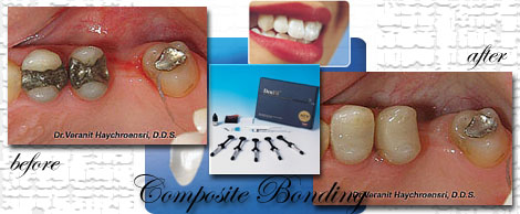 Composite Bonding by Phuket Dentist at Phuket Dental Clinic in Phuket,Thailand