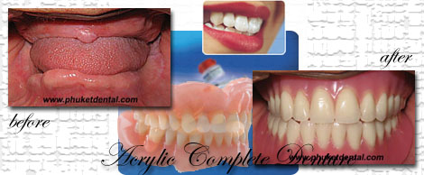 Complete Denture