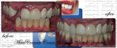 Vitallium Partial Denture with Metal Clasp