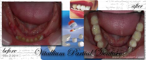 Vitallium Partial Denture with Metal Clasp