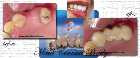 Ceramic/Titanium crowns&bridges by Phuket Dentist at Phuket Dental Clinic in Phuket,Thailand