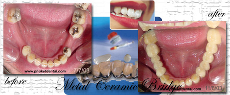 Ceramic/Titanium crowns&bridges by Phuket Dentist at Phuket Dental Clinic in Phuket,Thailand