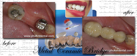 Ceramic/Titanium crowns&bridges by Phuket Dentist at Phuket Dental Clinic in Phuket,Thailand