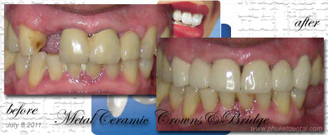 Ceramic/Titanium crowns&bridges by Phuket Dentist at Phuket Dental Clinic in Phuket,Thailand