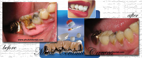 Ceramic/Titanium crowns&bridges by Phuket Dentist at Phuket Dental Clinic in Phuket,Thailand