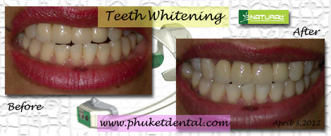 Tooth Whitening:non-LASER,LED,Natural Plus at Phuket Dental Clinic,Thailand