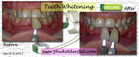 Tooth Whitening:non-LASER,LED,Natural Plus at Phuket Dental Clinic,Thailand