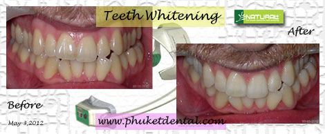 Tooth Whitening:non-LASER,LED,Natural Plus at Phuket Dental Clinic,Thailand