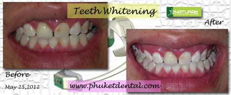 Tooth Whitening:non-LASER,LED,Natural Plus at Phuket Dental Clinic,Thailand