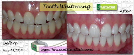 Tooth Whitening:non-LASER,LED,Natural Plus at Phuket Dental Clinic,Thailand