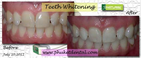 Tooth Whitening:non-LASER,LED,Natural Plus at Phuket Dental Clinic,Thailand