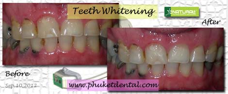 Tooth Whitening:non-LASER,LED,Natural Plus at Phuket Dental Clinic,Thailand