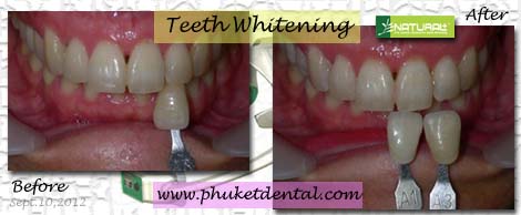 Tooth Whitening:non-LASER,LED,Natural Plus at Phuket Dental Clinic,Thailand