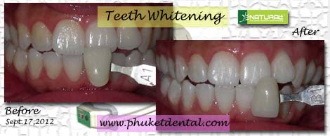 Tooth Whitening:non-LASER,LED,Natural Plus at Phuket Dental Clinic,Thailand