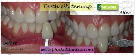 Tooth Whitening:non-LASER,LED,Natural Plus at Phuket Dental Clinic,Thailand