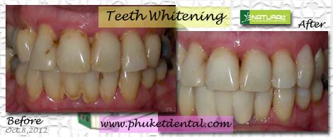 Tooth Whitening:non-LASER,LED,Natural Plus at Phuket Dental Clinic,Thailand