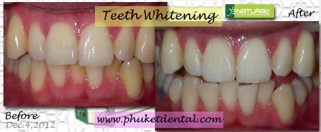 Tooth Whitening:non-LASER,LED,Natural Plus at Phuket Dental Clinic,Thailand