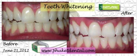 Tooth Whitening:non-LASER,LED,Natural Plus at Phuket Dental Clinic,Thailand