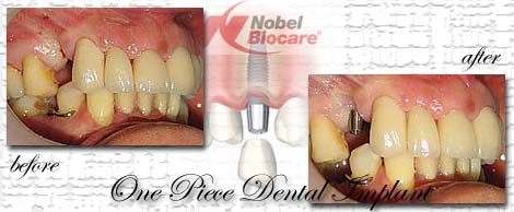 Dental Implants by Phuket Dentist at Phuket Dental Clinic in Phuket,Thailand